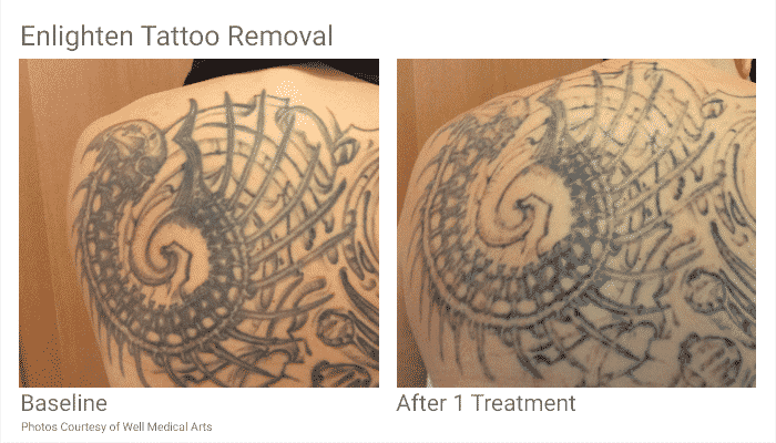 Seattle_TattooRemoval_BeforeandAfter_JZ - Well Medical Arts: Seattle's  Anti-Aging Clinic
