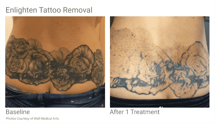 Seattle_TattooRemoval_BeforeandAfter_Wedekin_1 - Well Medical Arts:  Seattle's Anti-Aging Clinic