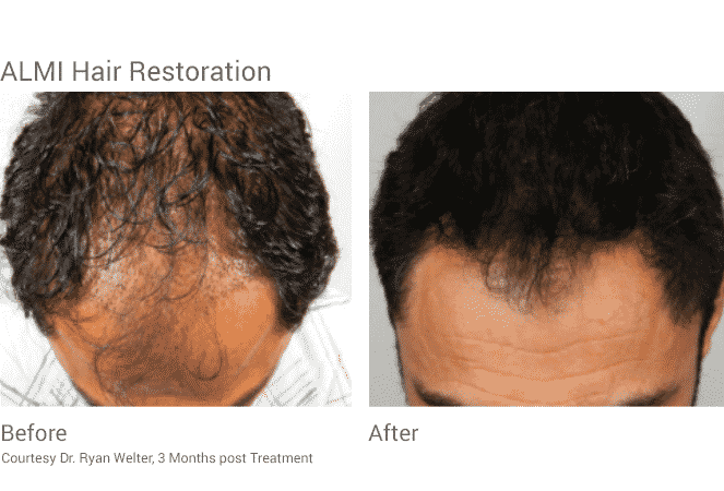 Almi Procedure Hair Restoration Seattle