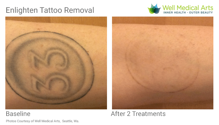 Tattoo After Gallbladder Removal | Tattoo Removal