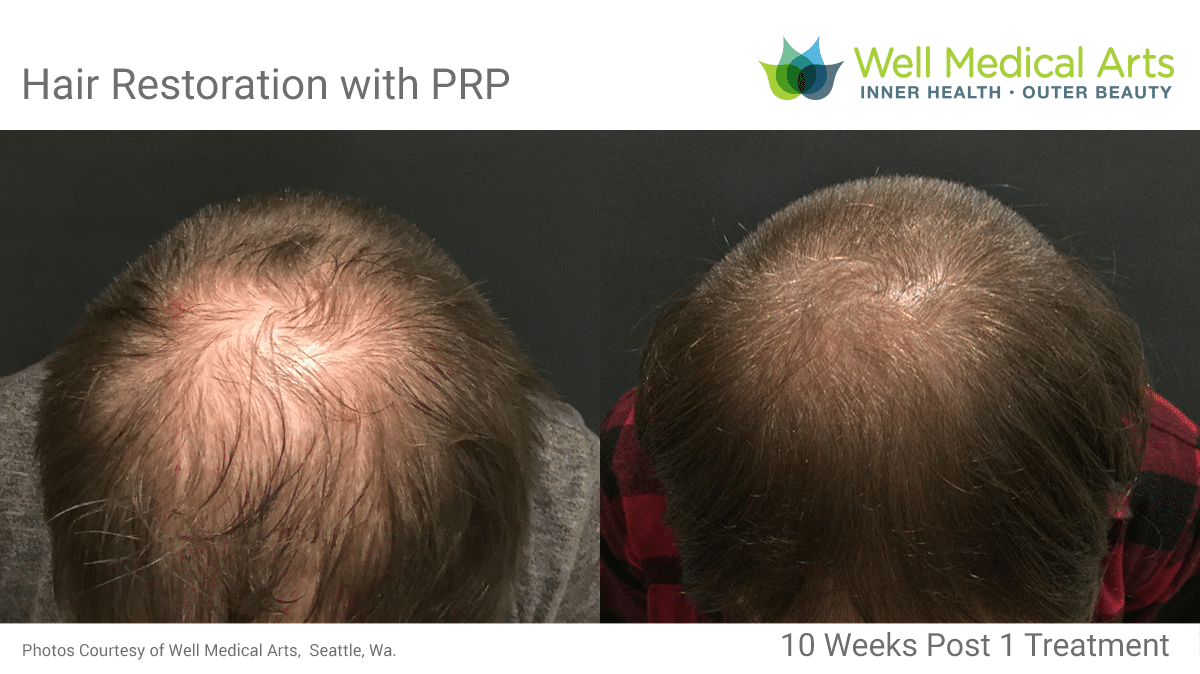 Hair Restoration Prp Acell Before After Seattle Well Medical Arts