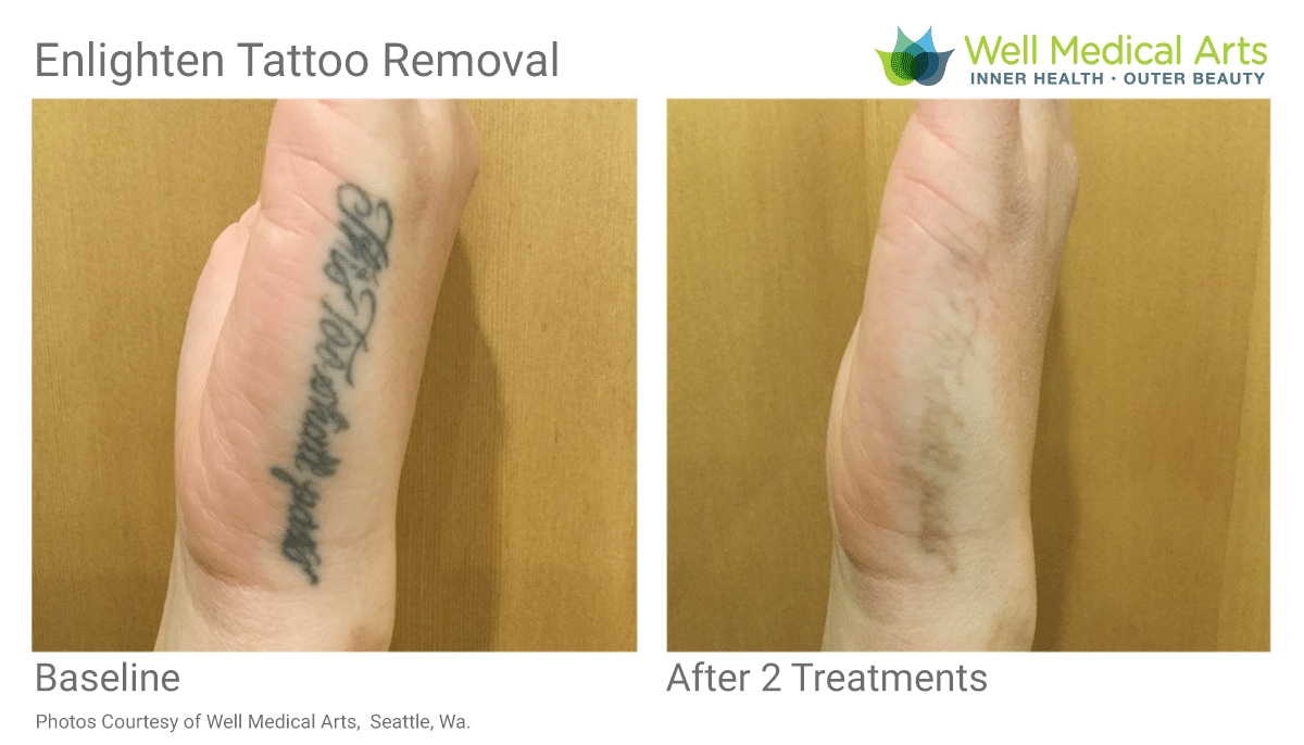 Tattoo Removal in Seattle using Pico Technology at Well ...