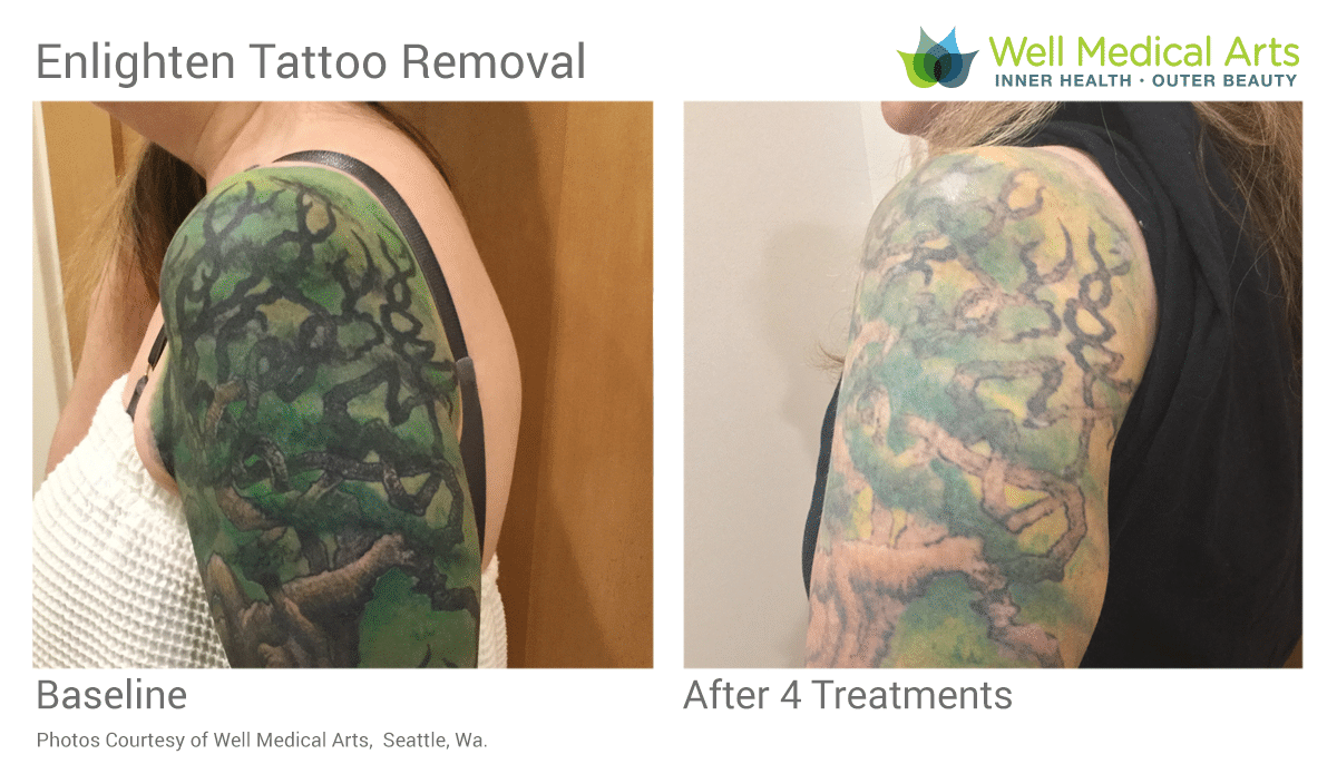 Tattoo Removal in Seattle using Pico Technology at Well ...