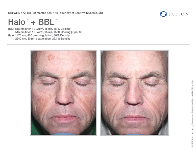 halo-bbl-well-medical-arts-seattle-s-anti-aging-clinic