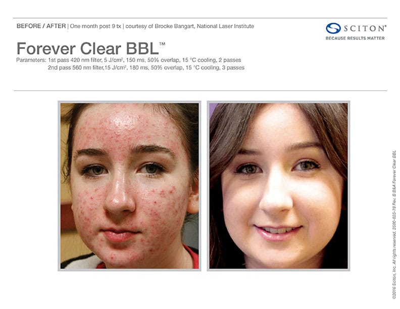 forever-clear-bbl-acne-treatment-well-medical-arts-seattle-s