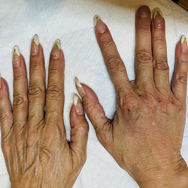 bellafill-hand-rejuvenation-well-medical-arts-seattle-s-anti-aging
