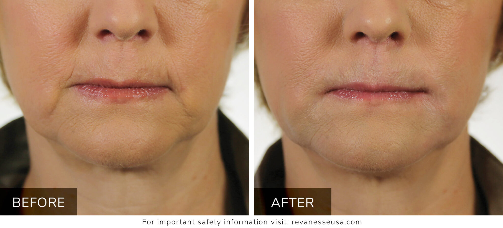 Versa Dermal Filler, Great for Cheeks, Lips, Creases and Folds