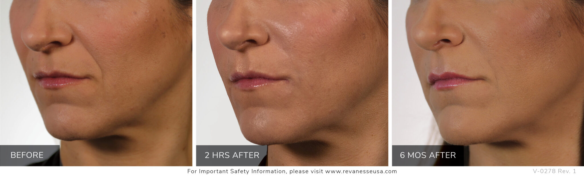 Versa Dermal Filler, Great for Cheeks, Lips, Creases and Folds