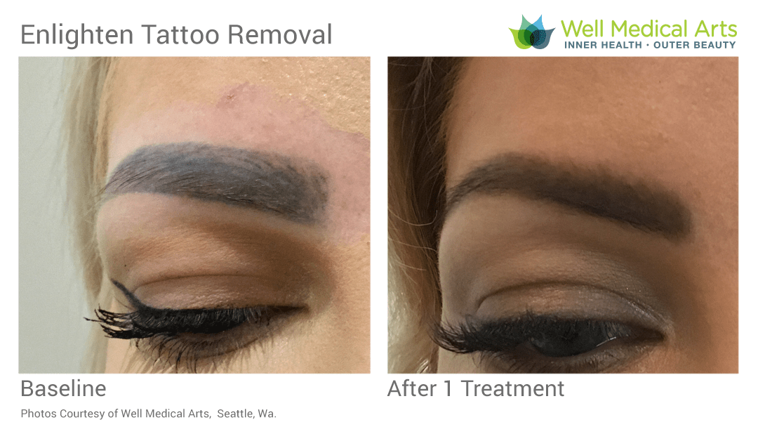 Eyebrow Tattoo Removal Seattle Well Medical Arts Before After