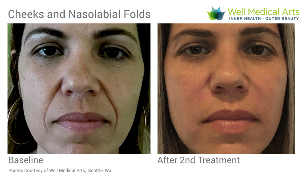 Cheeks and Nasolabial folds Well Medical Arts Seattle