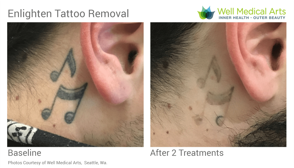 Seattle Tattoo Removal Before and After at Well Medical Arts