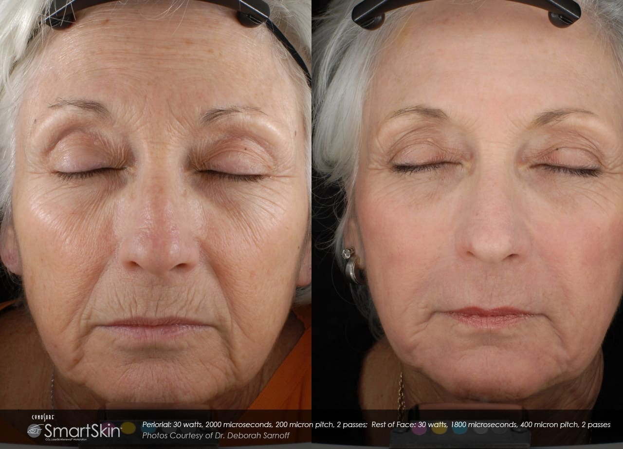 Get A Brand New Skin SmartSkin Co2 Fractional Resurfacing In Seattle At Well Medical Arts