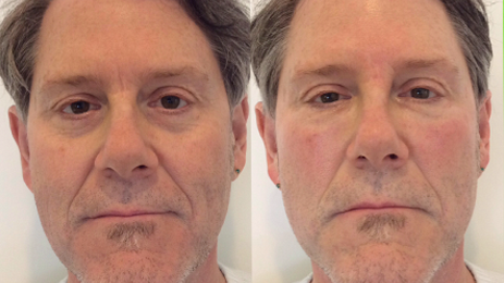 Bellafill Tear Trough Treatment To Reduce The Appearance Of Black Bags Under The Eyes. Call Well Medical Arts In Seattle At 206-935-5689 To Schedule Your Consultation.