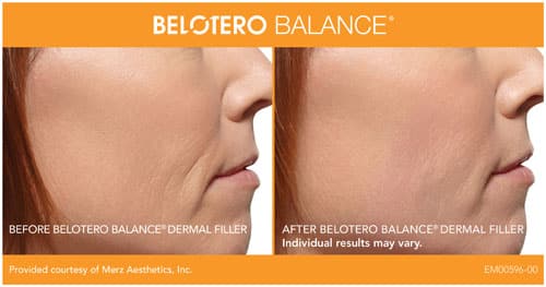 In Seattle We Use Belotero Filler For Taking Care Of Fine Lines And Adding The Finishing Touch.