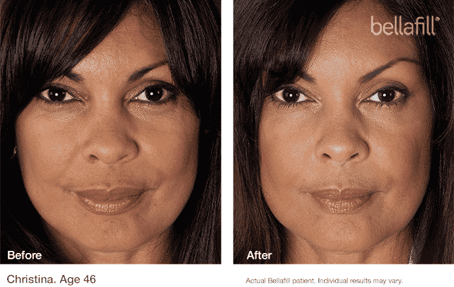 We are a Seattle Bellafill top 1% provider. Bellafill is the longest lasting dermal filler available with the longest safety study of any dermal filler on the market. Bellafill is a semi-permanent dermal filler that lasts up to 5 years! Yes 5 years!