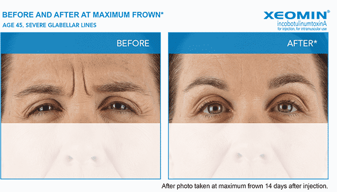 Experienced the expert Seattle Xeomin injector