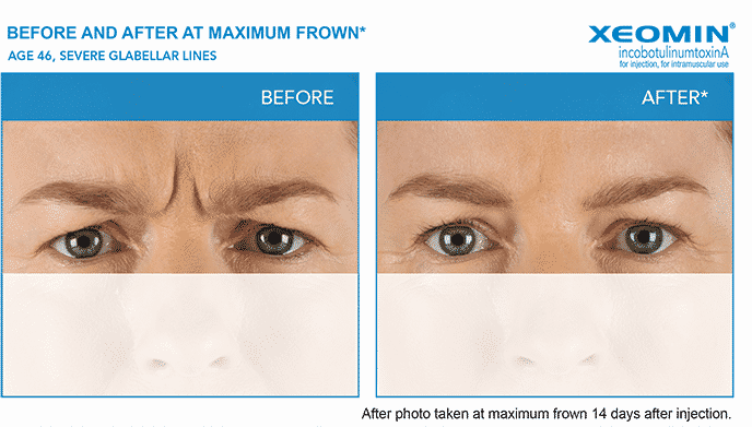 Experienced the expert Seattle Xeomin injector