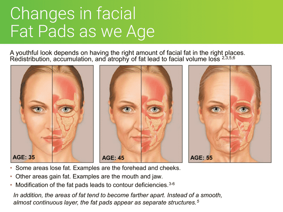 Changes in facial fat pads as we age contribute to a sagging face. When we replace the lost volume of fat with dermal fillers we can restore a more youthful appearance.