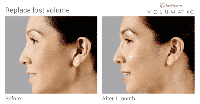 Experienced The Expert Seattle Voluma Injector