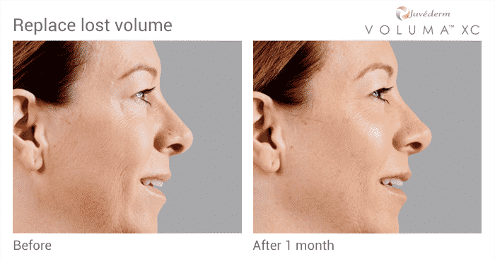 Experienced The Expert Seattle Voluma Injector