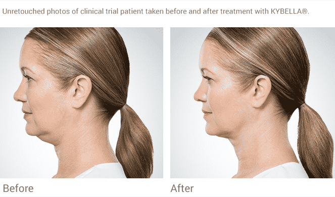 Seattle Kybella At Well Medical Arts. Kybella Is The New Injectable That Permanently Dissolves Fat With A Quick Non-invasive Procedure Providing Contour To The Lower Face And Jawline.