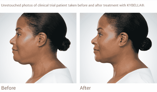 Seattle Kybella At Well Medical Arts. Kybella Is The New Injectable That Permanently Dissolves Fat With A Quick Non-invasive Procedure Providing Contour To The Lower Face And Jawline.