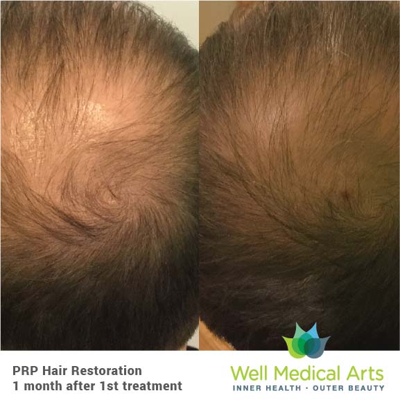 8x8_SocialMediaPosts-26 Seattle PRP Hair Restoration - 1 Month post 1 Treatment