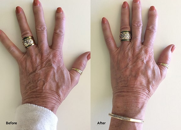 Radiesse Is Now Indicated For The Hands. We Are Pleased To Offer Hand Rejuvenation At Well Medical Arts.