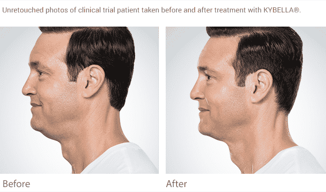 Eliminate The Double Chin In Seattle With Kybella At Well Medical Arts