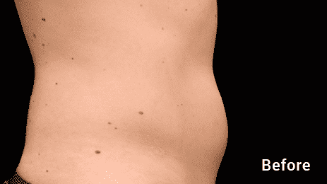 See CoolSculpting Before And Afters And Learn More About CoolSculpting In Seattle At