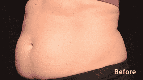 Get Rid Of That Stubborn Belly Fat With Our Seattle Coolsculping Treatments. Coolsculpting Is The #1 Non Invasive Fat Reduction Treatment. Call 206-935-5689 To Schedule Your Consultation.