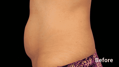 Get Rid Of That Stubborn Belly Fat With Our Seattle Coolsculping Treatments. Coolsculpting Is The #1 Non Invasive Fat Reduction Treatment. Call 206-935-5689 To Schedule Your Consultation.