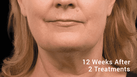 Get Rid Of That Double Chin In Seattle With Coolsculpting. We Are The Only Coolsculpting In West Seattle. Call 206-935-5689 To Schedule Your Appointtment.