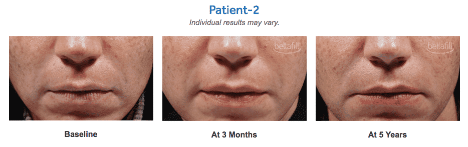 Dominique Well At Well Medical Arts Is Seattle's Very Own Expert Bellafill Injector. Bellafill Is The Longest Lasting Dermal Filler Available, Lasting Up To 5 Years.