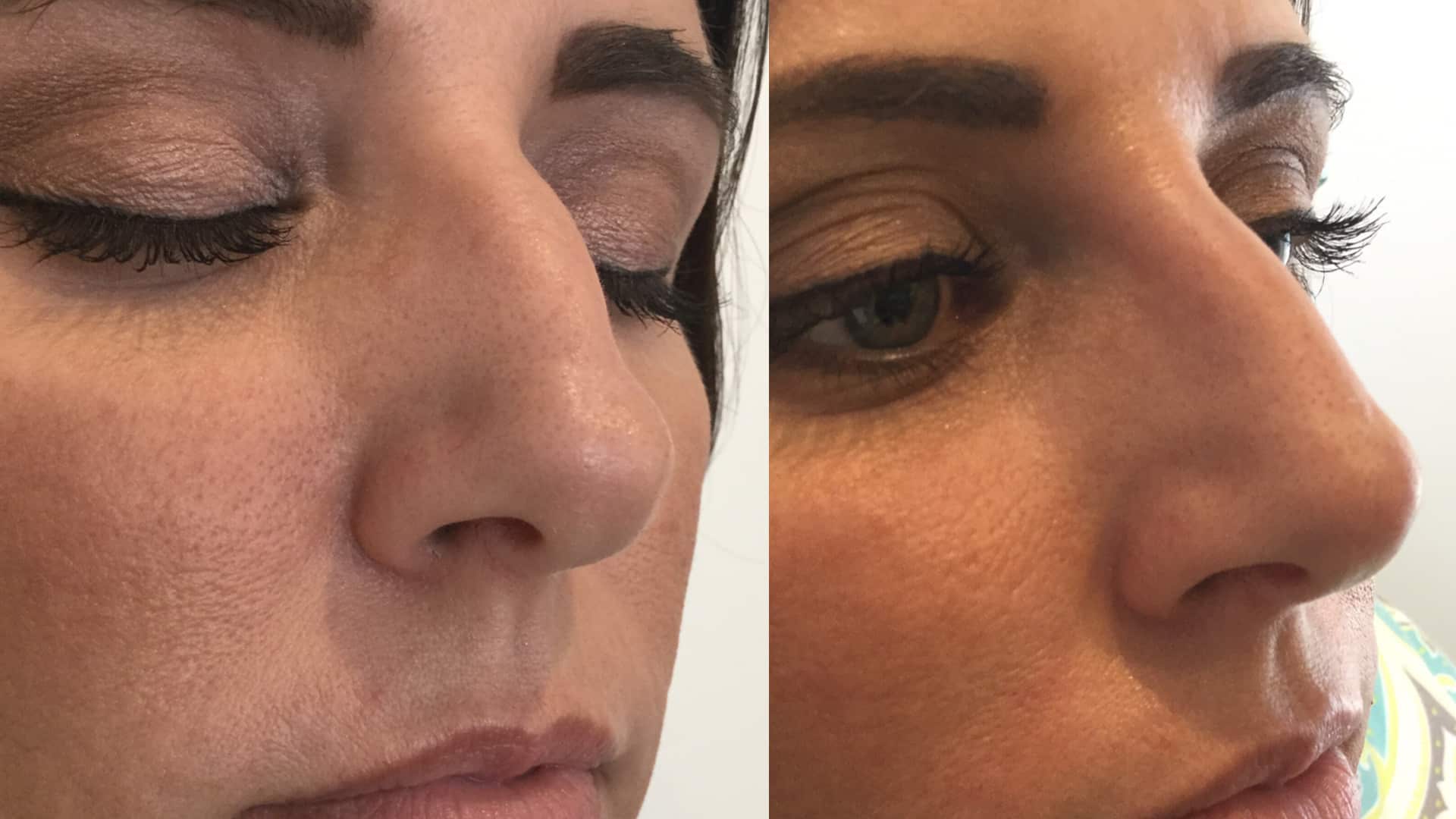 Asian - Ethnic Rhinoplasty Seattle Bellevue