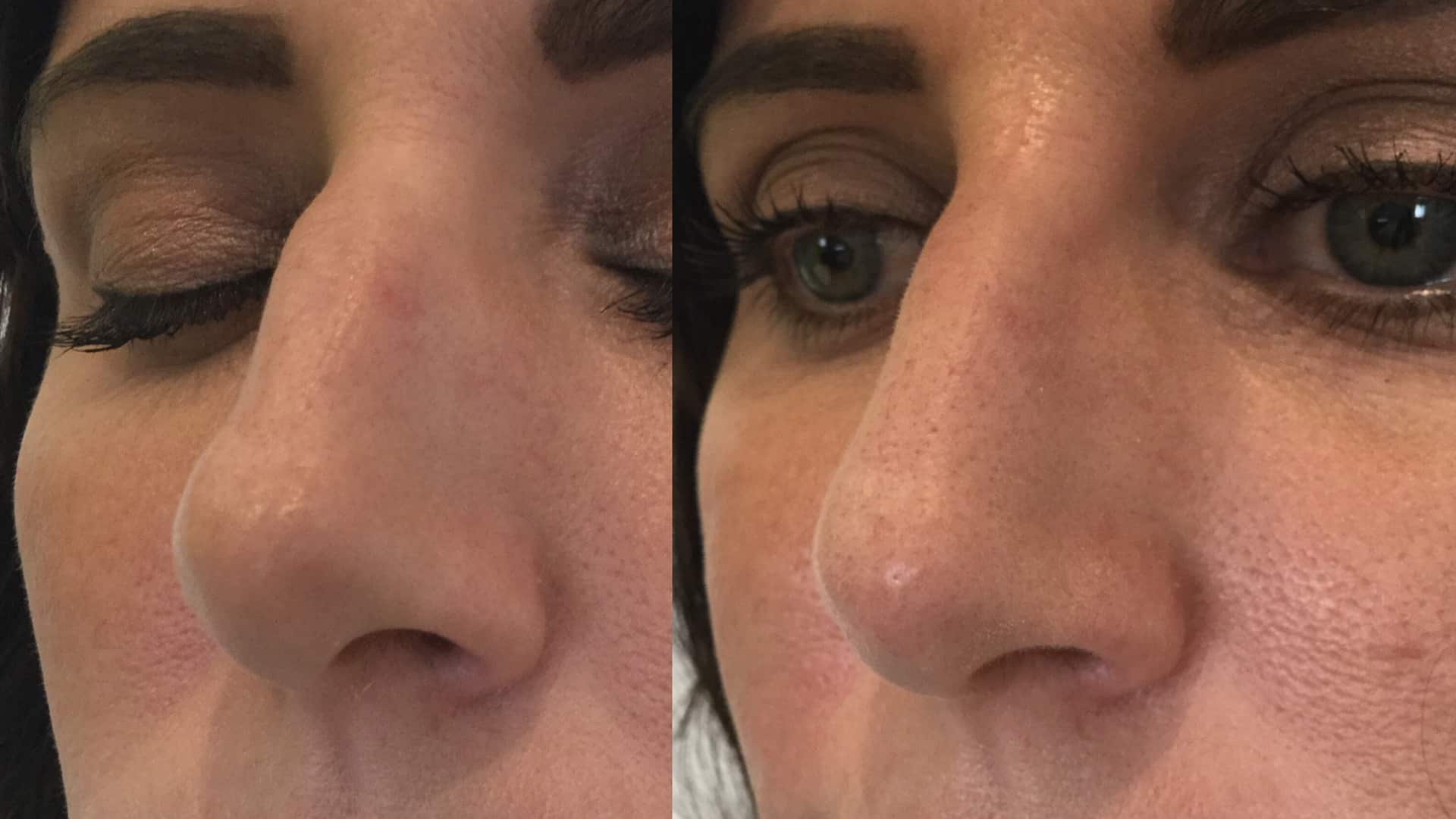 Non-Surgical Rhinoplasty in Seattle at Well Medical Arts