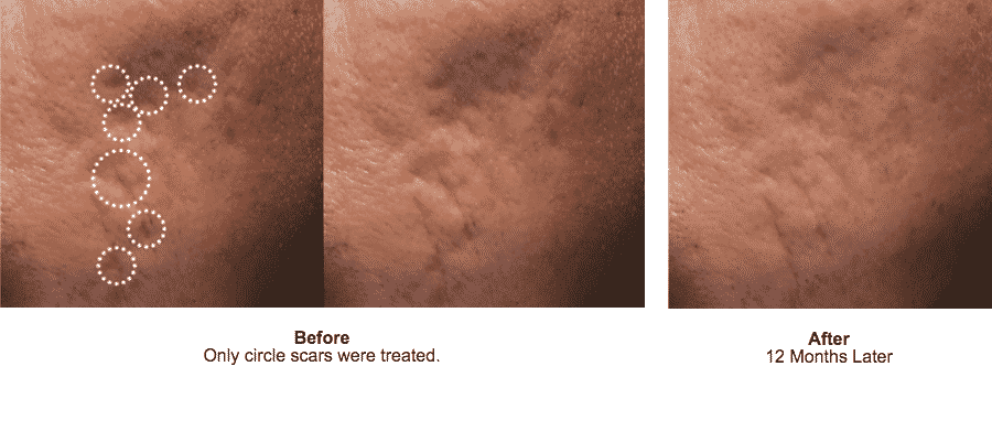Bellafill For Acne Scars Before And After. Bellafill Is The Only FDA Approved Dermal Long Lasting Dermal Filler For The Treatment Of Acne Scars.