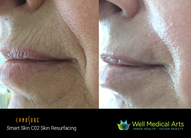 Seattle Co2 Fractional Laser Treatments At Well Medical Arts. Erase Years Worth Of Fine Lines From Your Face. Treat Scars And Sebaceous Hyperplasia. Call Well Medical Arts At 206-935-5689 To Schedule Your Consultation.
