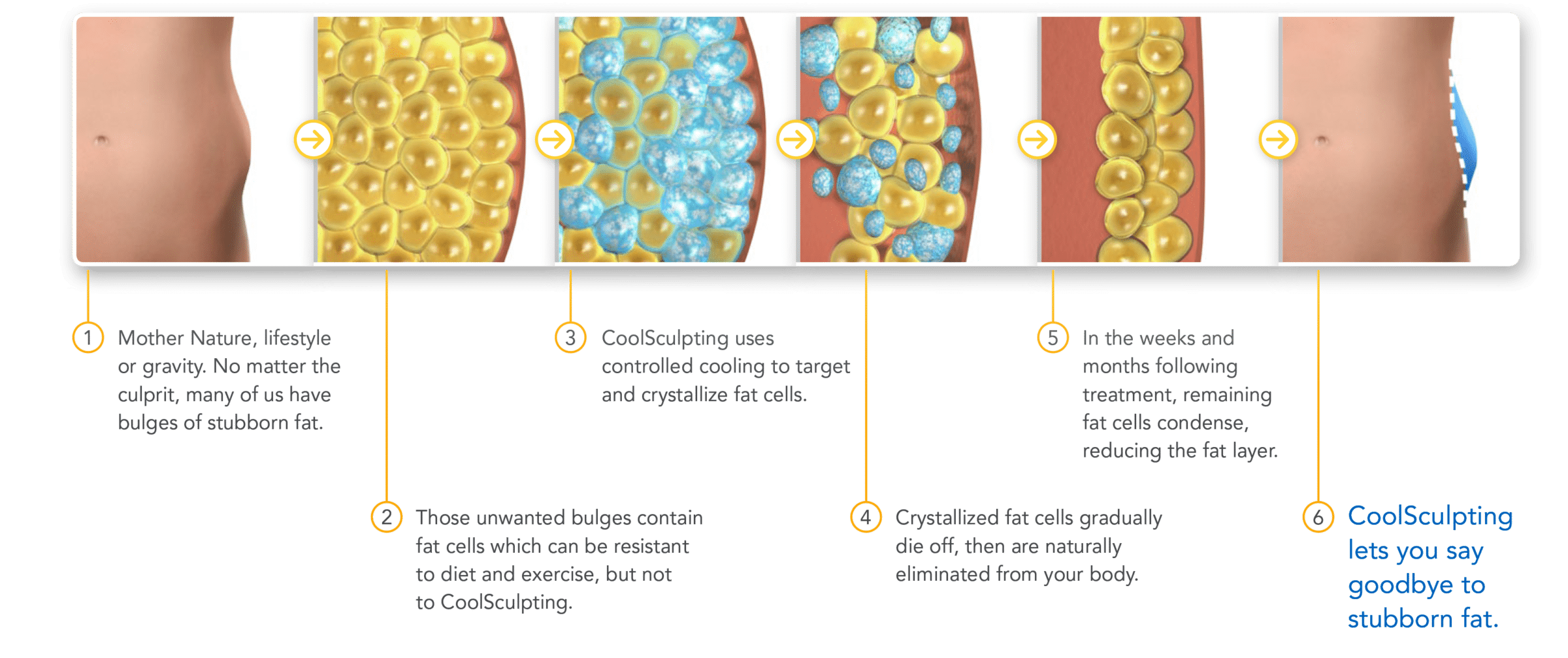A visual diagram of how coolsculpting works. Call the Seattle CoolSculpting experts, Well Medical Arts at 206-935-5689 to schedule your consultation.