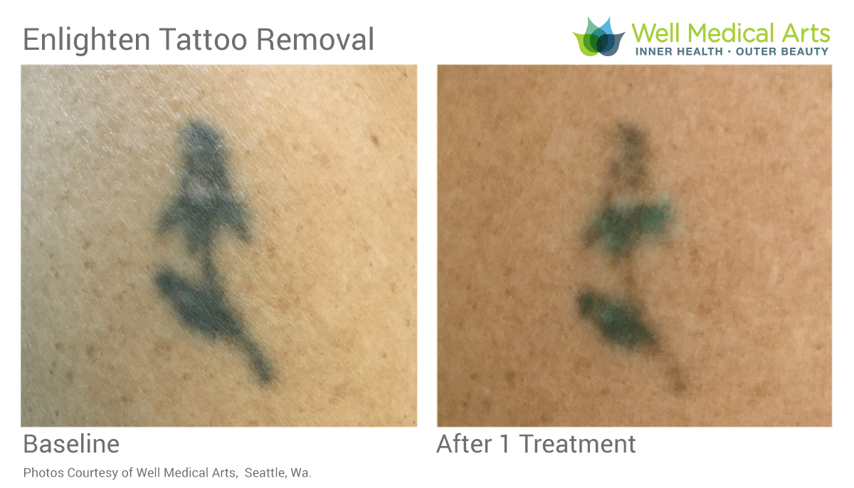 2nd Treatment Session Of Laser Tattoo Removal In Seattle On A Small Tattoo At Well Medical Arts.