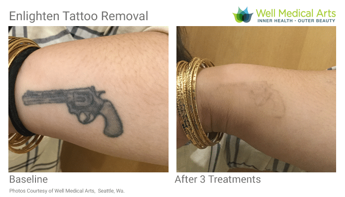 More Awesome Laser Tattoo Removal Results In Seattle At Well Medical Arts. Call 206-935-5689 To Schedule Your Consultation.