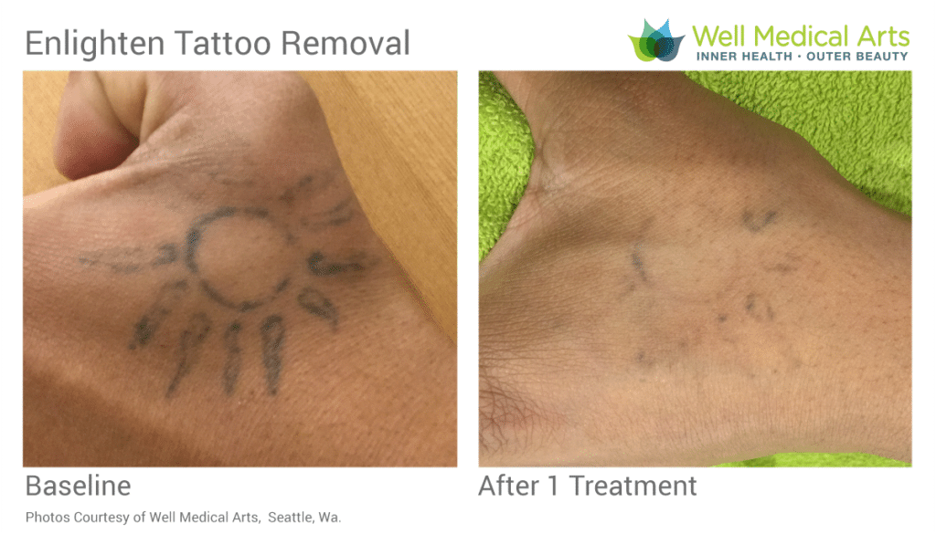 Tattoo Removal Seattle Well Medical Arts Before After AV