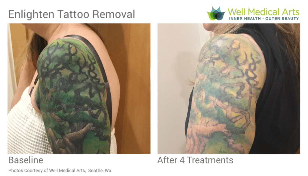 Discover more than 66 learn laser tattoo removal best  thtantai2