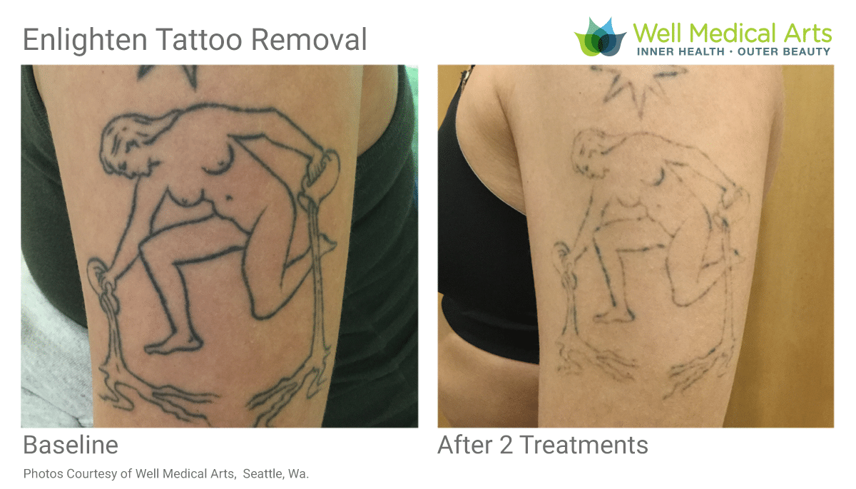 How Does Laser Tattoo Removal Work  Satin Med Spa