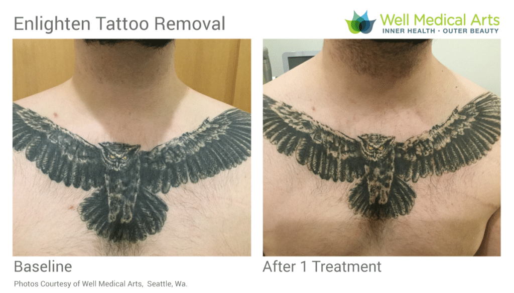 Tattoo Removal  Before and After Images