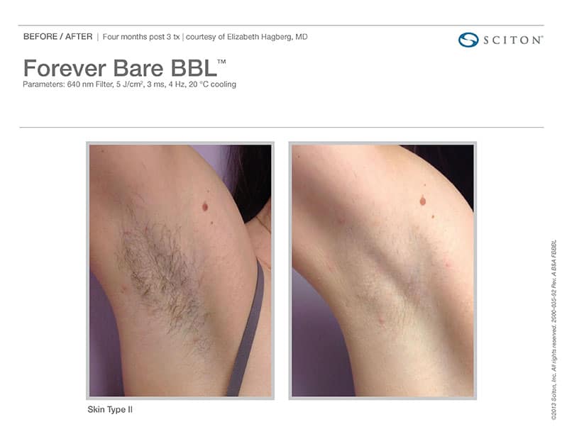 Laser Hair Removal Before And After.