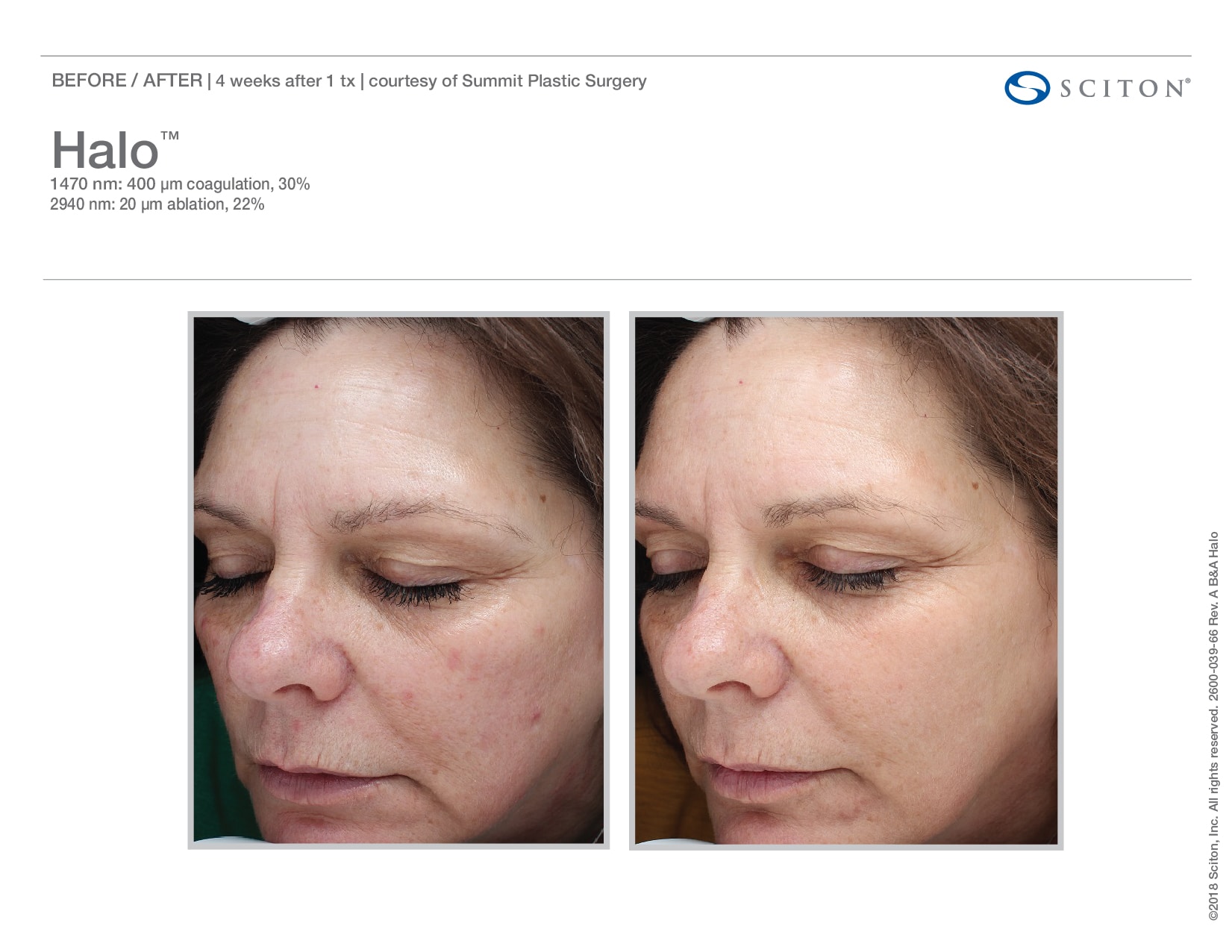 Before And After From Halo Fractional Laser. Halo Is Available At Well Medical Arts In Seattle. Call 206-935-5689 To Schedule Your Treatment Now.