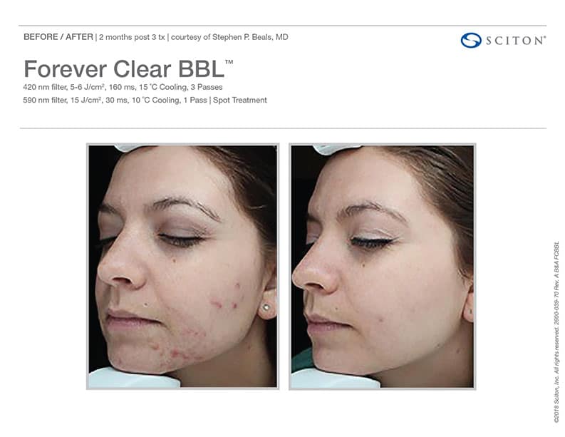 Before and After images of Acne treatment with the Forever Clear BBL at Wel...