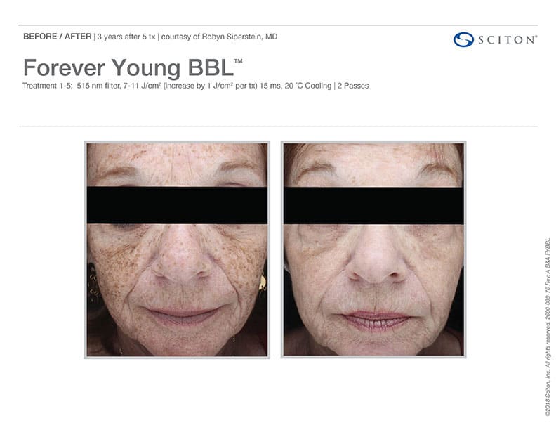 Forever Young BBL Treatment Before And After Images. Call Well Medical Arts In Seattle At 206-935-5689 To Schedule Your Treatment.