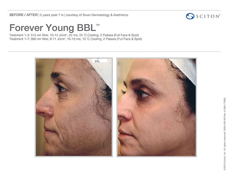 Forever Young BBL Treatment Before And After Images. Call Well Medical Arts In Seattle At 206-935-5689 To Schedule Your Treatment.